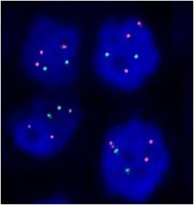 Figure 1: Interphase FISH analysis of (a) FTC (FC-03) showing trisomy nuclei with three orange and two green signal pattern;